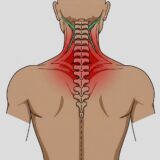 Nackenschmerzen schematisch erklärt